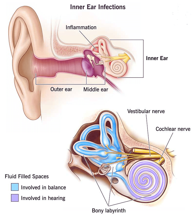 Inner Ear Infections