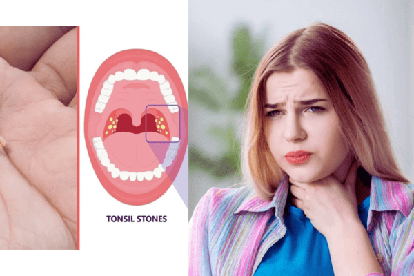 What Causes Tonsil Stones